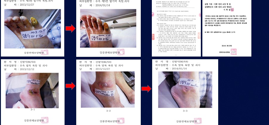 욕창·족부궤양 캘비 파우더 천연 겔 처치 기록